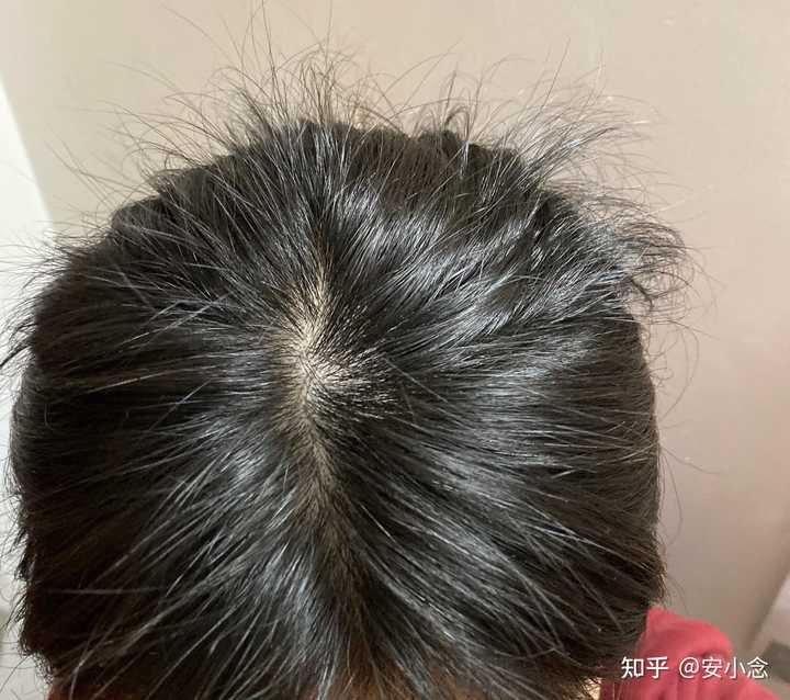 脱发补锌有用吗（脱发补锌用有什么好处）-硒宝网