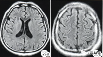 血钠低怎么补（低钠血症补钠补不上去）-硒宝网