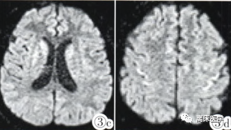 血钠低怎么补（低钠血症补钠补不上去）-硒宝网