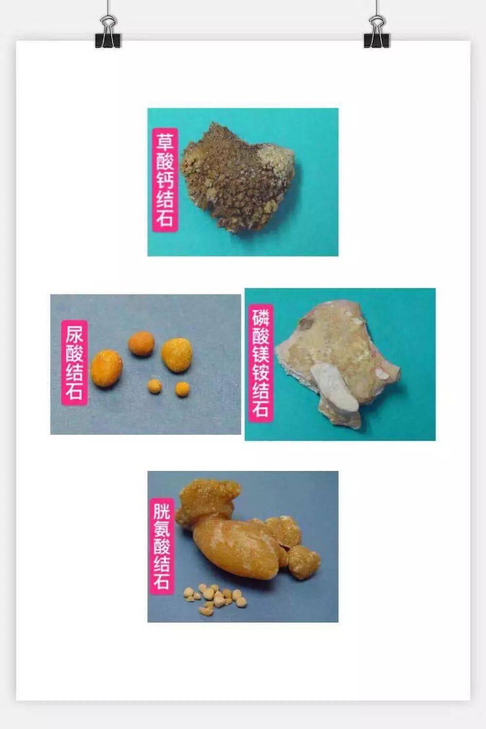 结石病人能补钙吗（病人能结石补钙片吗）-硒宝网