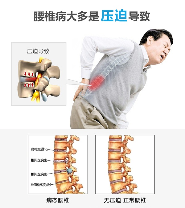 腰椎间盘突出能补钙吗(腰间盘突出能补钙吗视频)-硒宝网