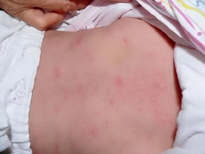 锌硒宝片会过敏吗（过敏锌片宝硒会过敏吗）-硒宝网