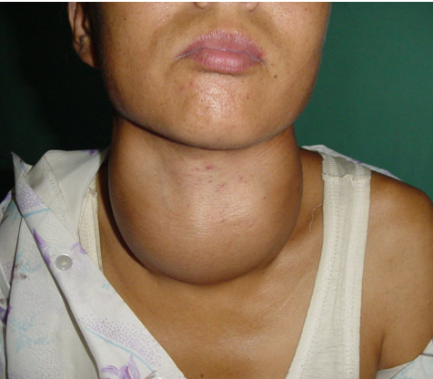 什么食物补碘（食物补碘需要多久时间）-硒宝网