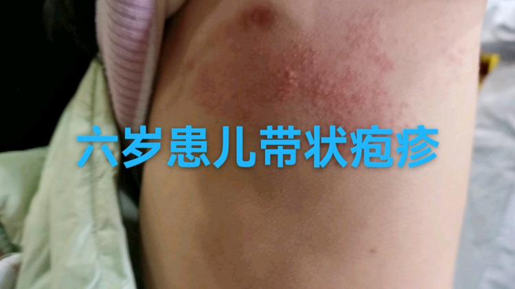 锌硒宝治带状疱疹（带状疱疹善存）-硒宝网