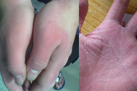 低钠血症补钠（低钠血症补钠补不上去）-硒宝网