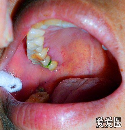 低钠血症补钠（低钠血症补钠补不上去）-硒宝网