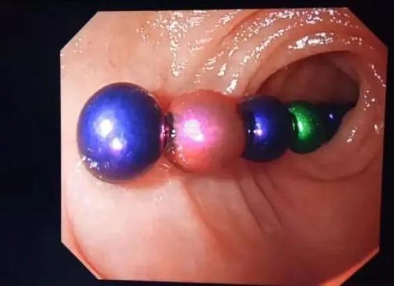 低钠血症补钠（低钠血症补钠补不上去）-硒宝网