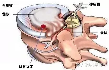 腰椎间盘突出要补钙吗（腰椎盘突出要补钙吗）-硒宝网