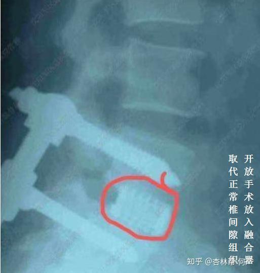 腰椎间盘突出要补钙吗（腰椎盘突出要补钙吗）-硒宝网