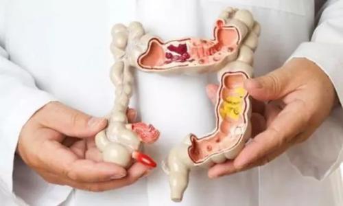 肠癌晚期补硒的危害（癌症晚期补硒能让肿瘤消失吗）-硒宝网