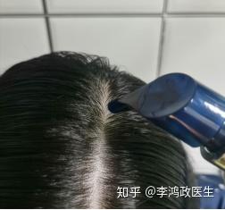 头屑多可以补硒吗女（补硒可以治疗脱发吗）-硒宝网