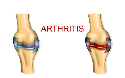 补硒对骨骼有好处吗（硒对骨骼的作用）-硒宝网