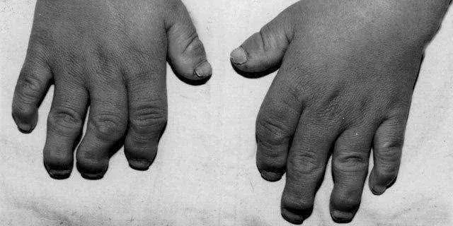 补硒对骨骼有好处吗（硒对骨骼的作用）-硒宝网