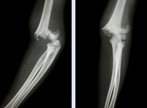 补硒对骨骼有好处吗（硒对骨骼的作用）-硒宝网