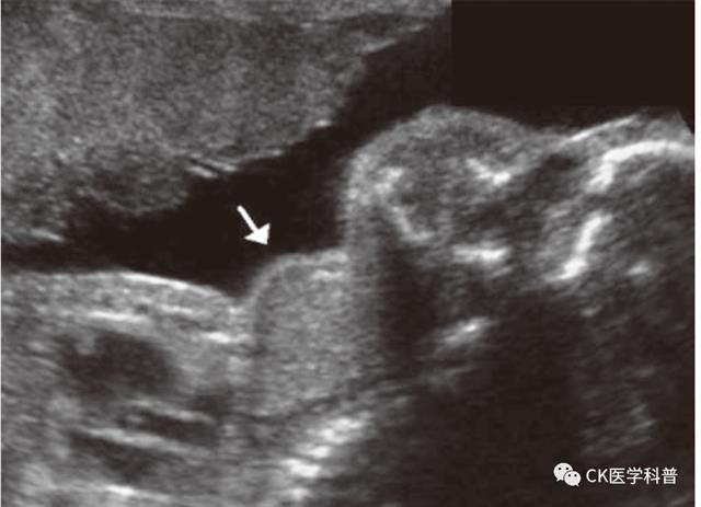 亚临床甲减补硒疗程(亚临床甲减服用硒酵母)-硒宝网