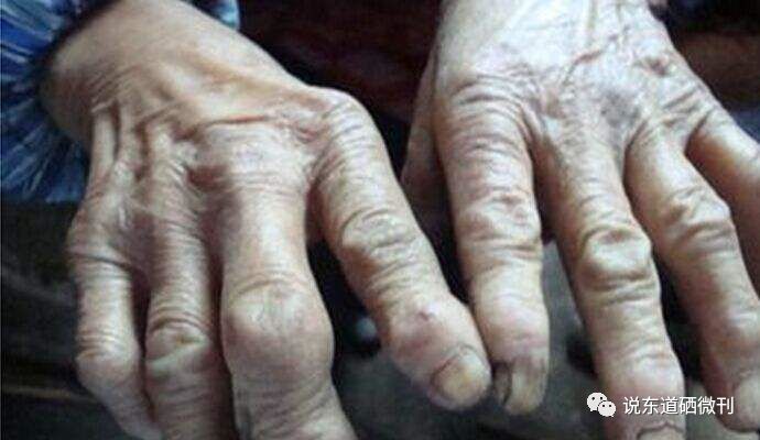 补硒对骨骼有好处吗（骨骼好处补硒有用吗）-硒宝网