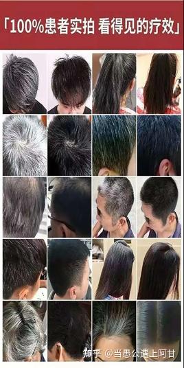 补硒治好了我的白发(白发治补好硒会变黑吗)-硒宝网