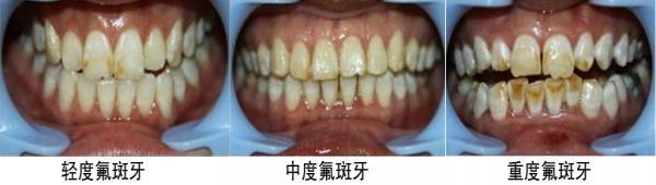 补硒对血脂高好吗吗（硒与血脂的关系）-硒宝网