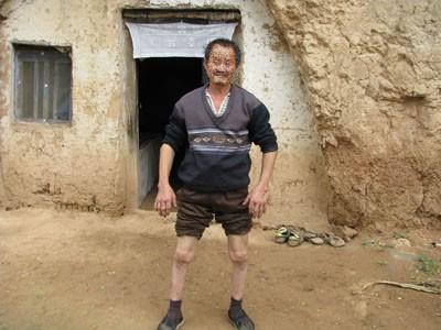 补硒对血脂高好吗吗（硒与血脂的关系）-硒宝网