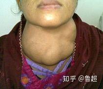 补硒对血脂高好吗吗（硒与血脂的关系）-硒宝网