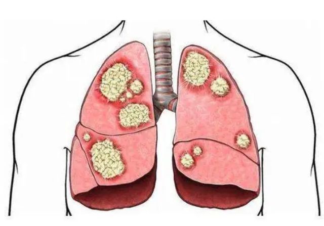 晚期肝癌补硒怎么补(肝癌晚期吃硒能控制吗)-硒宝网