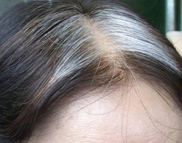 头发白缺什么微量元素（缺微量头发元素白发会多吗）-硒宝网