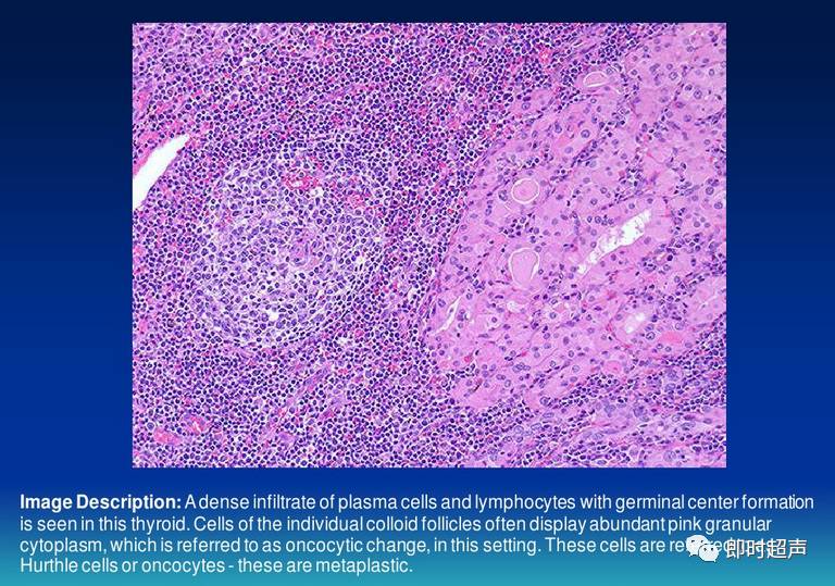 甲状腺结节补硒好吗（甲状腺结节补硒）-硒宝网