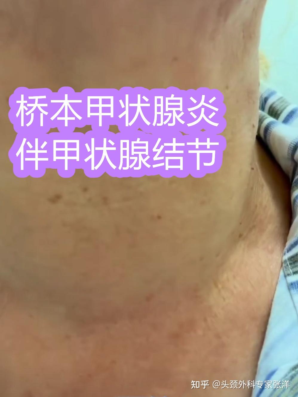 甲状腺结节补硒好吗(甲状腺结节补硒有好处吗)-硒宝网