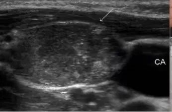 甲状腺结节补硒行吗(甲状腺结节补硒)-硒宝网