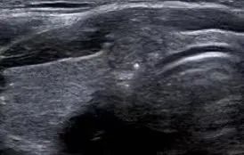 甲状腺结节补硒行吗(甲状腺结节补硒)-硒宝网