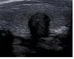 甲状腺结节补硒行吗(甲状腺结节补硒)-硒宝网