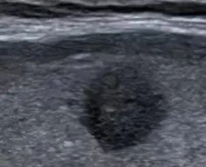 甲状腺结节补硒行吗(甲状腺结节补硒)-硒宝网