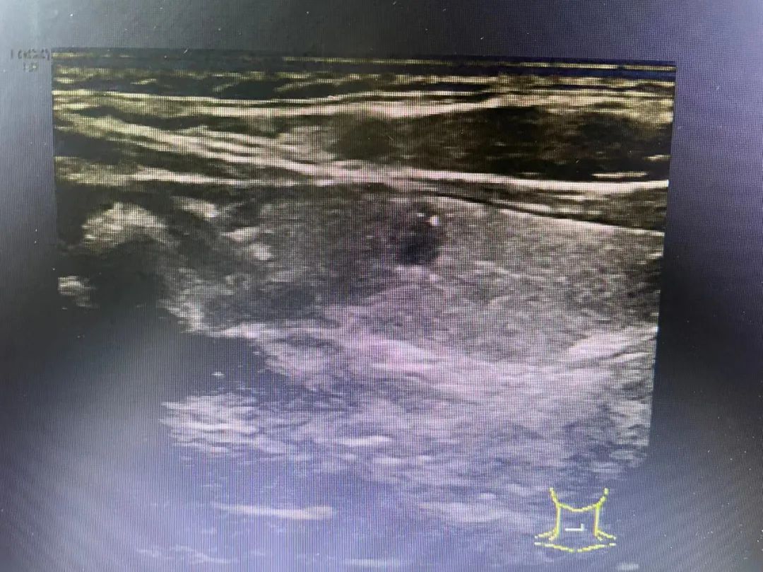 甲状腺结节补硒行吗(甲状腺结节补硒)-硒宝网