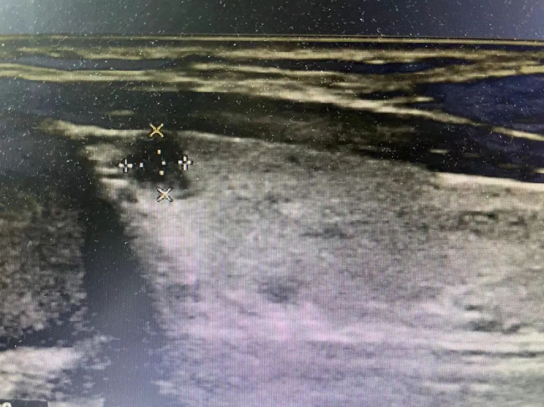 甲状腺结节补硒行吗(甲状腺结节补硒)-硒宝网