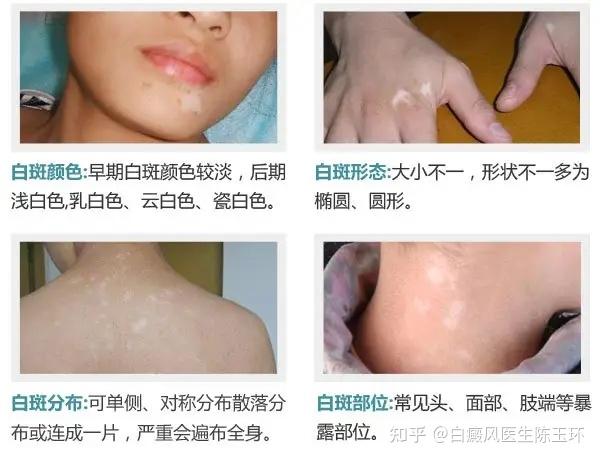 白癜风补硒效果好吗(补硒保健品什么牌子好)-硒宝网