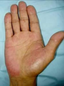 补硒导致转氨酶升高（升高补导致转氨酶硒的药物）-硒宝网