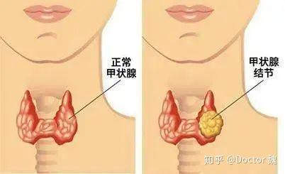 甲状腺患者补硒好吗（甲状腺疾病补硒）-硒宝网