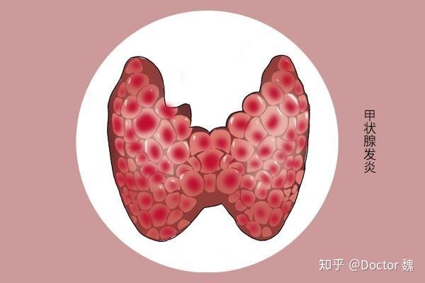 甲亢医生建议补硒吗(甲亢病人补硒)-硒宝网