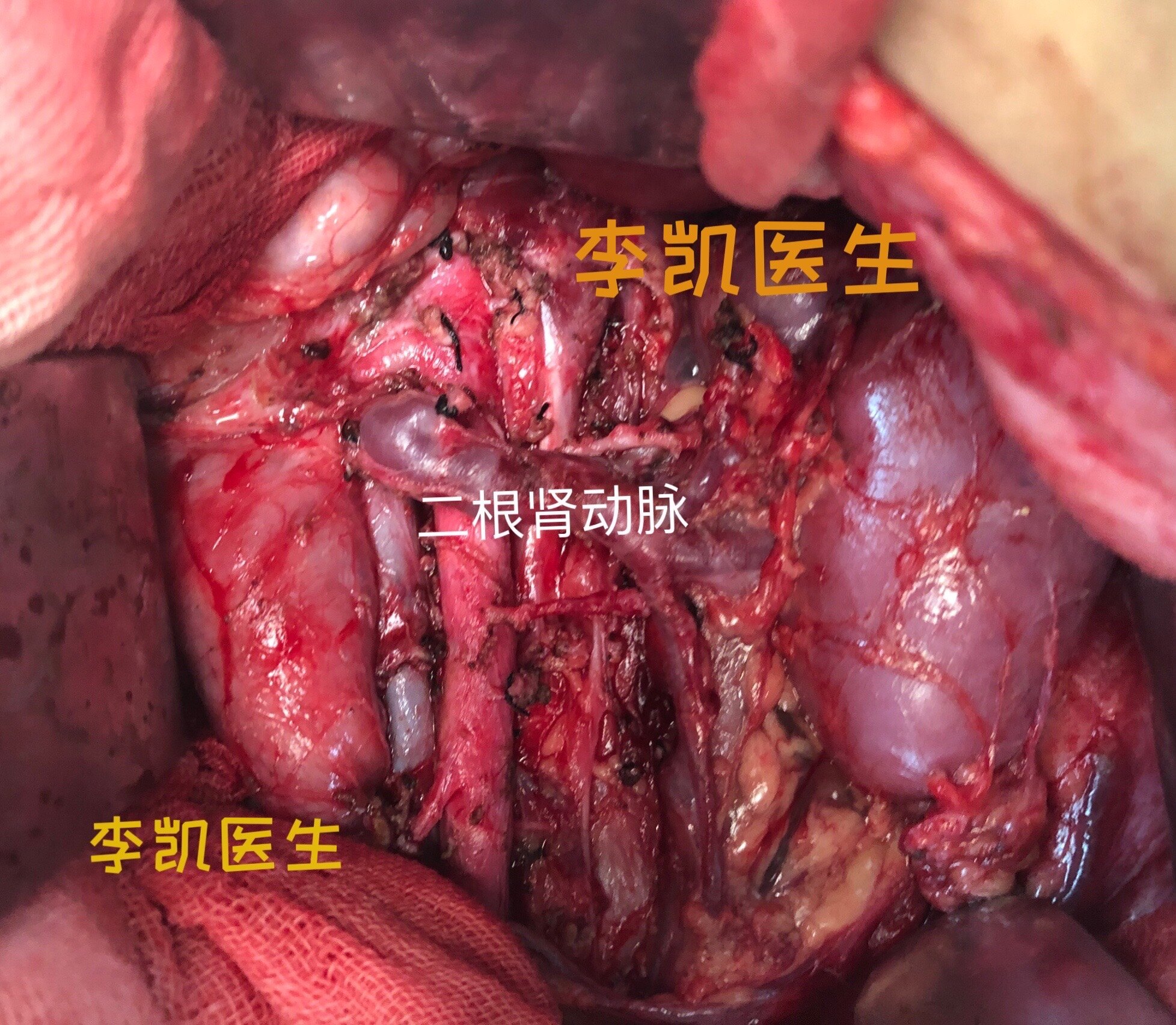 iga肾病能补硒吗（肾病可以吃硒元素吗）-硒宝网