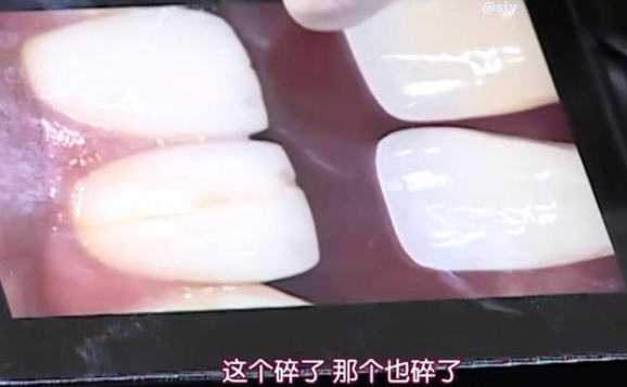 补钙对牙齿有好处吗（补钙对牙齿的作用）-硒宝网