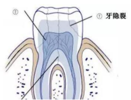 补钙对牙齿有好处吗（补钙对牙齿的作用）-硒宝网