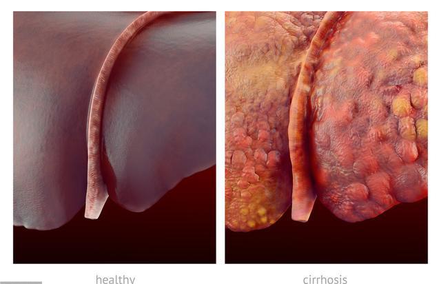 肝硬化患者如何补硒（肝硬化患者缺硒吗）-硒宝网