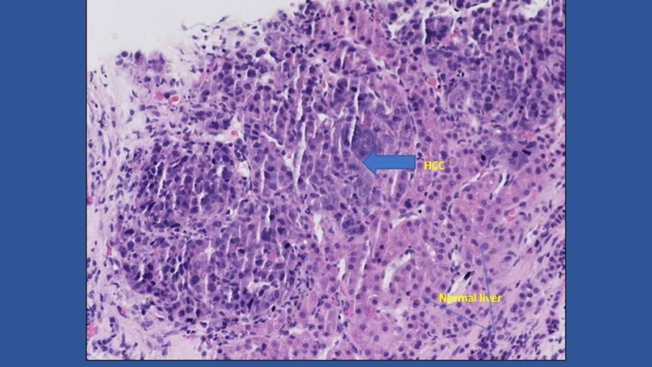 补硒可以软化肝硬化（肝硬化软化补硒可以长期吃吗）-硒宝网