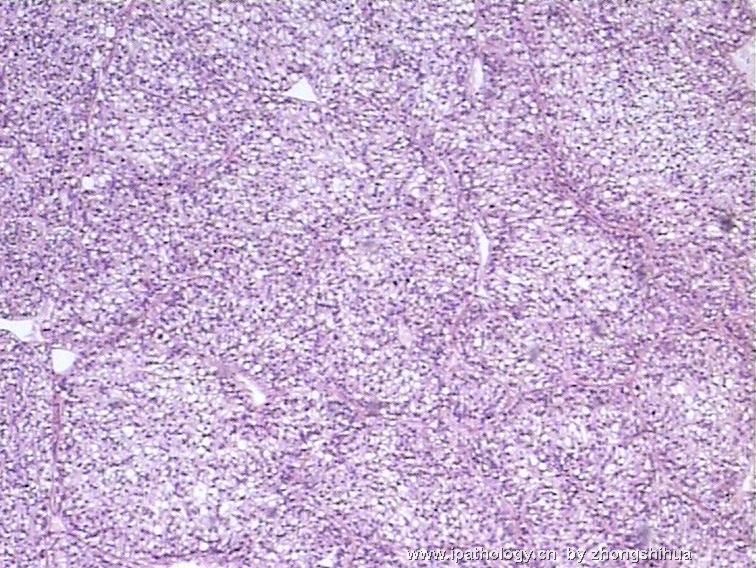 补硒可以软化肝硬化（肝硬化软化补硒可以长期吃吗）-硒宝网