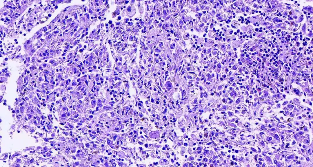 补硒可以软化肝硬化（肝硬化软化补硒可以长期吃吗）-硒宝网