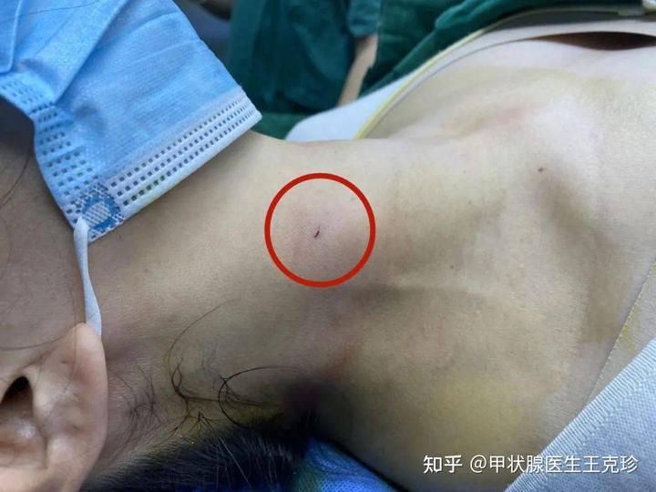 甲状腺结节能补硒嘛(甲状腺结节补充硒元素有用吗)-硒宝网