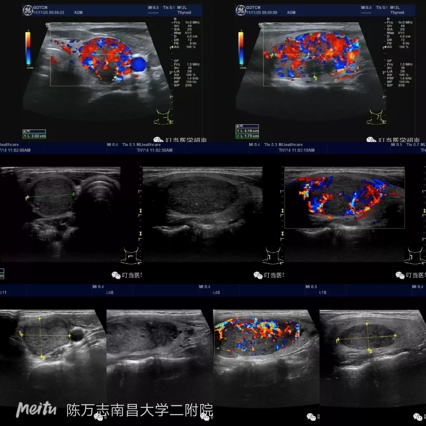 甲状腺结节能补硒嘛(甲状腺结节补硒)-硒宝网