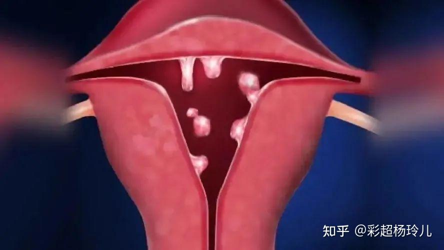 内膜息肉可以补硒吗（有内膜息肉可以吃维生素e吗）-硒宝网