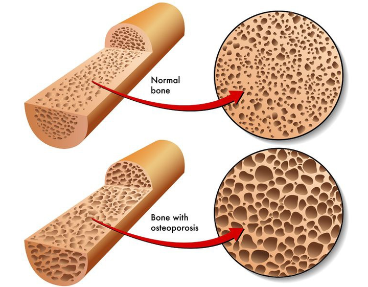 老年人怎样补钙（补钙老年人吃什么食物最好最快）-硒宝网