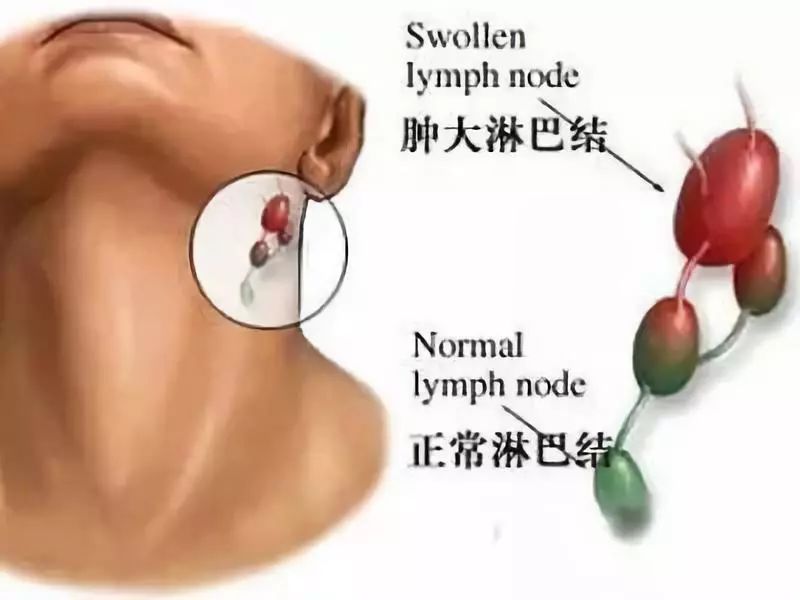 癌症中晚期补硒有用（癌症晚期补硒能让肿瘤消失吗）-硒宝网